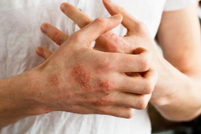 Wszystko, co musisz wiedzieć o atopowym zapaleniu skóry